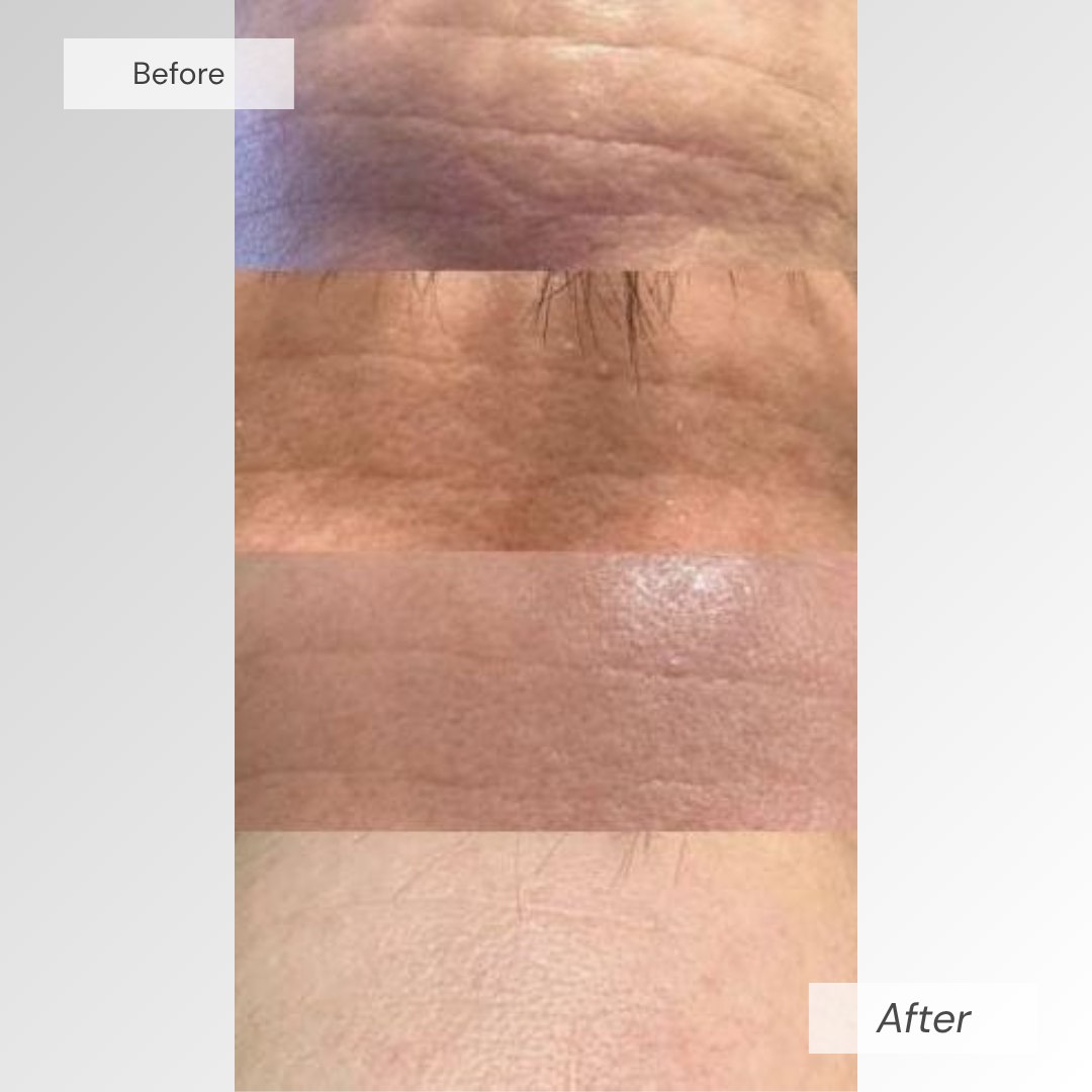 PureGlow™ Red Light Therapy Mask